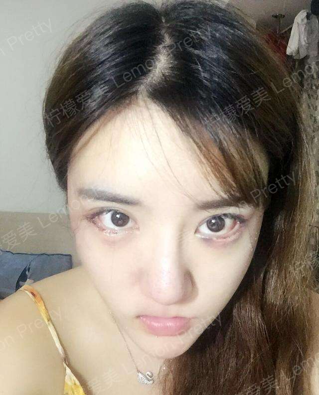 完成了我一直的心愿 做了开外眼角 下眼睑下至