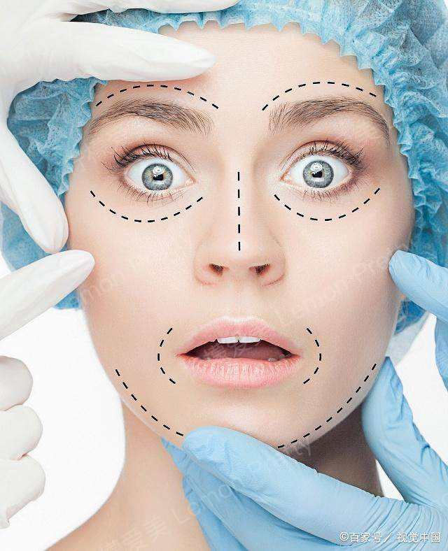 线雕大v线,线雕大v脸多久恢复,大v线提升有副作用吗