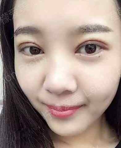 美女做了全切双眼皮,看到恢复20天的照片,是不是做的太宽了