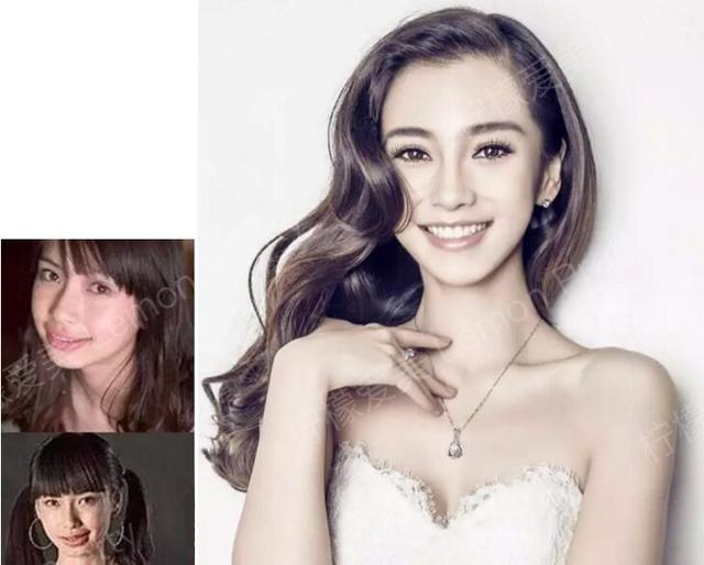 angelababy曾经的牙齿就不太整齐,后来拔了智齿,带了牙套矫正之后,就