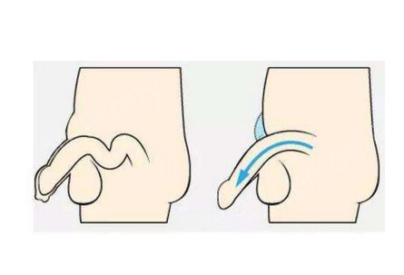 那么,在做了阴茎增大手术以后会留下哪些后遗症呢?