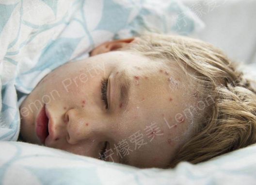 水痘凹陷疤痕修复呢