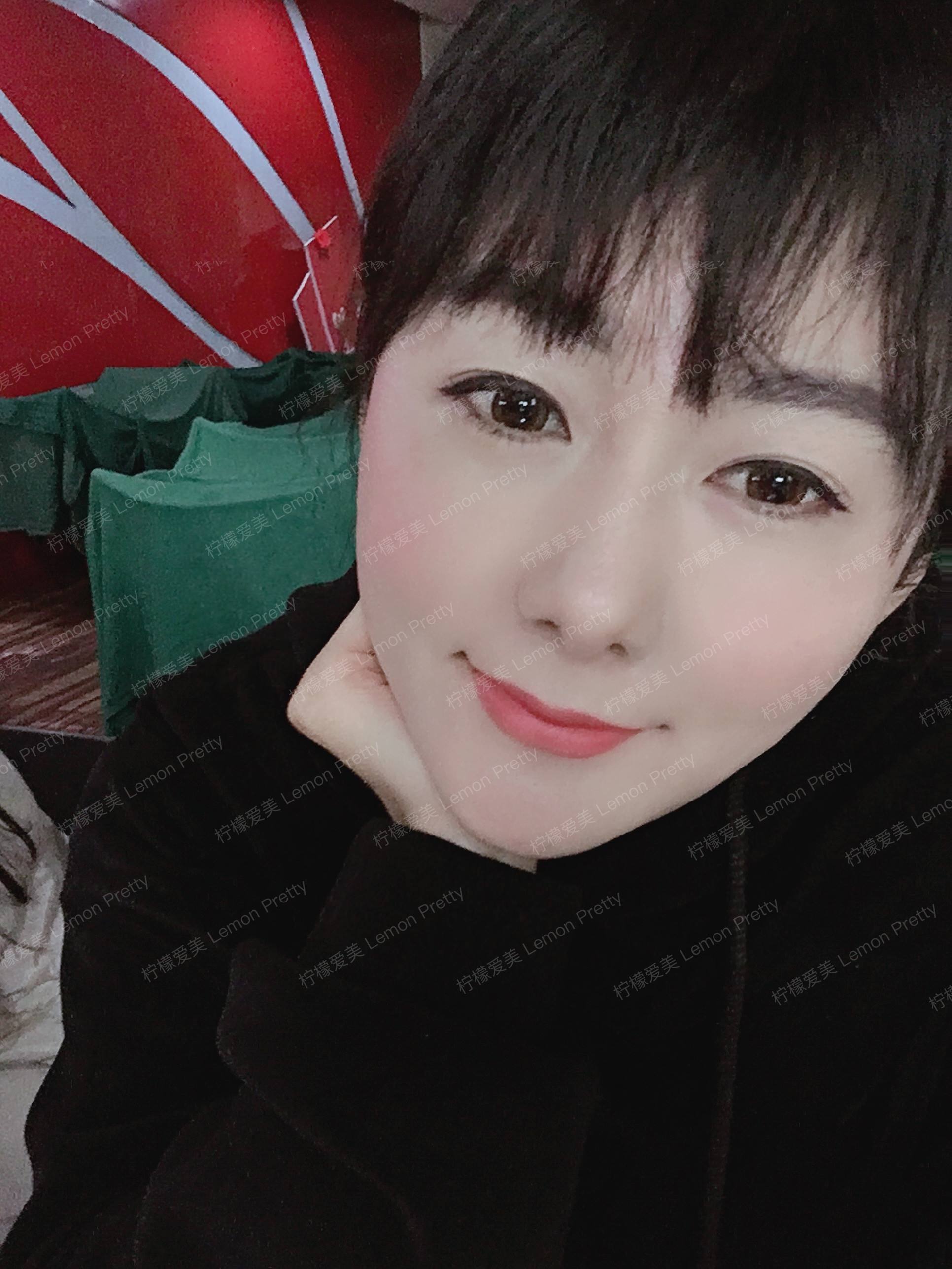 术后第42天变美日记_柠檬爱美_自体脂肪全脸填充