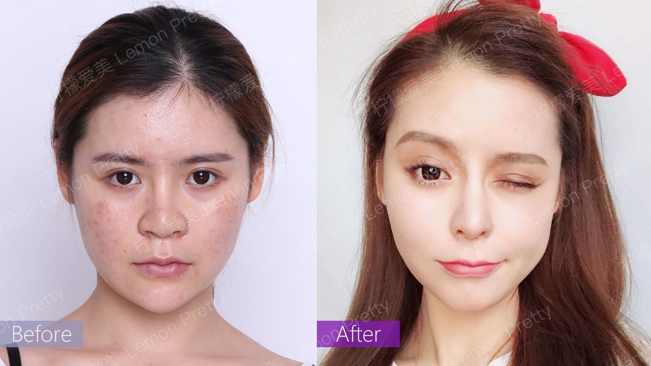 手术缩鼻头和缩鼻翼管用吗?