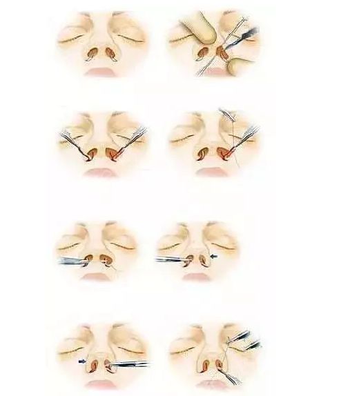 三,鼻翼缩小手术是怎么做的?