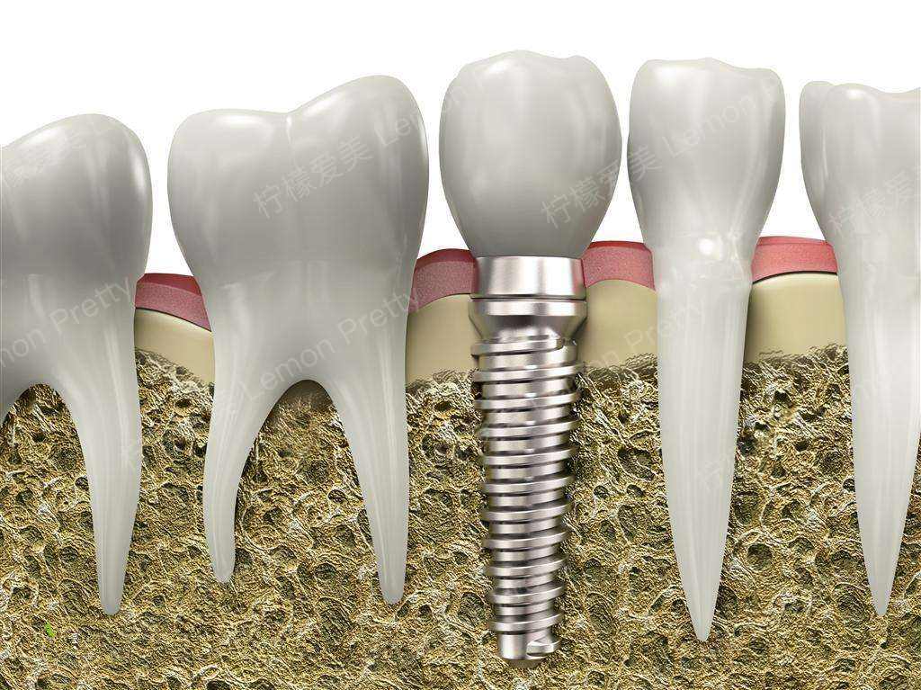 7个理由让你选择牙齿种植 种植牙的优势多_柠檬爱美_种植牙