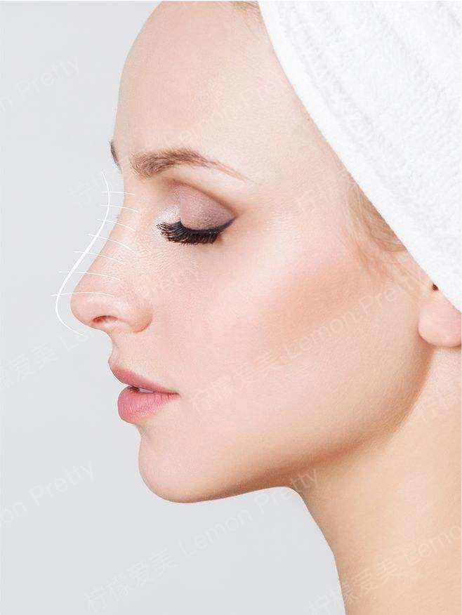 隆鼻山根多久消肿定型?