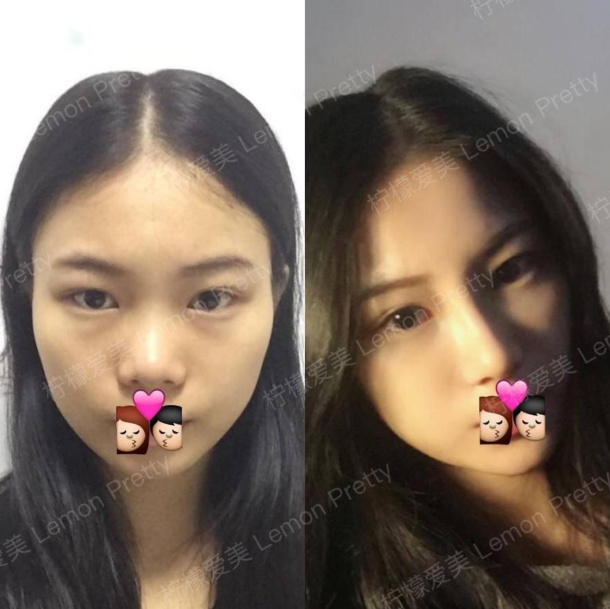 假体隆鼻取出假体后能恢复原样吗?鼻子会不会变塌?