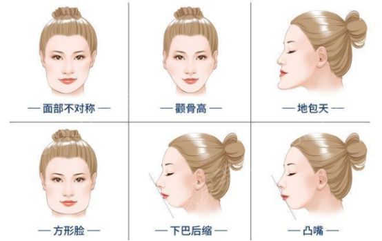 颌面整形之必要_柠檬爱美_下颌角整形修复,磨骨瘦脸,颧骨颧弓整形术