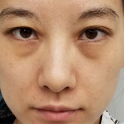 天    外切去眼袋    肿胀期第1篇日记