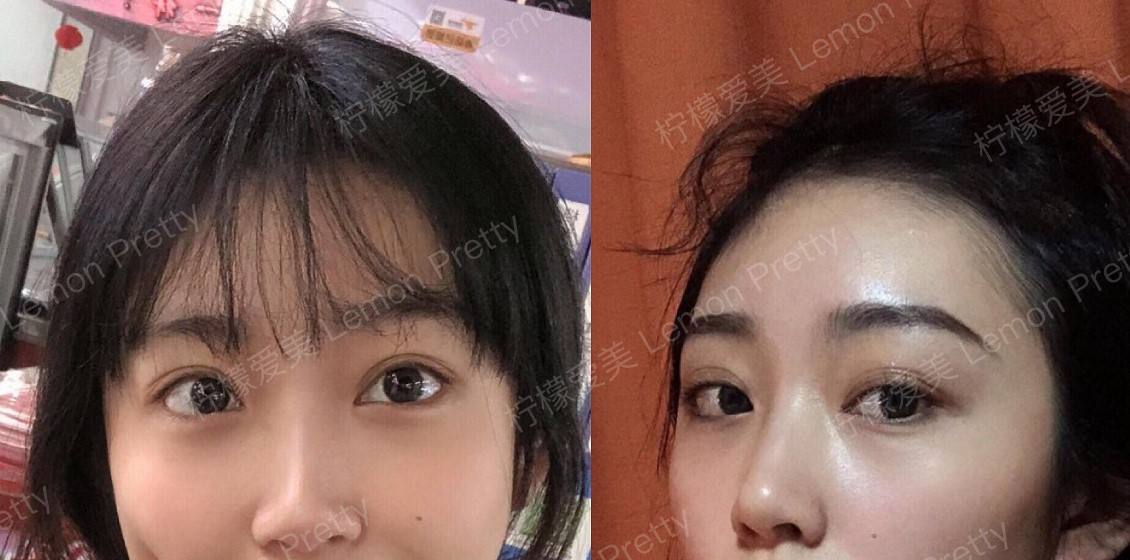 硅胶垫鼻子不满意,取出来会变形吗?能不能恢复原样?