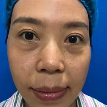 外切眼袋外翻是什么原因?外切眼袋手术多久能恢复好?