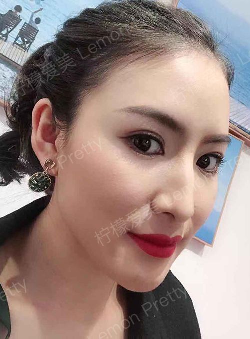 脸部打玻尿酸的后遗症