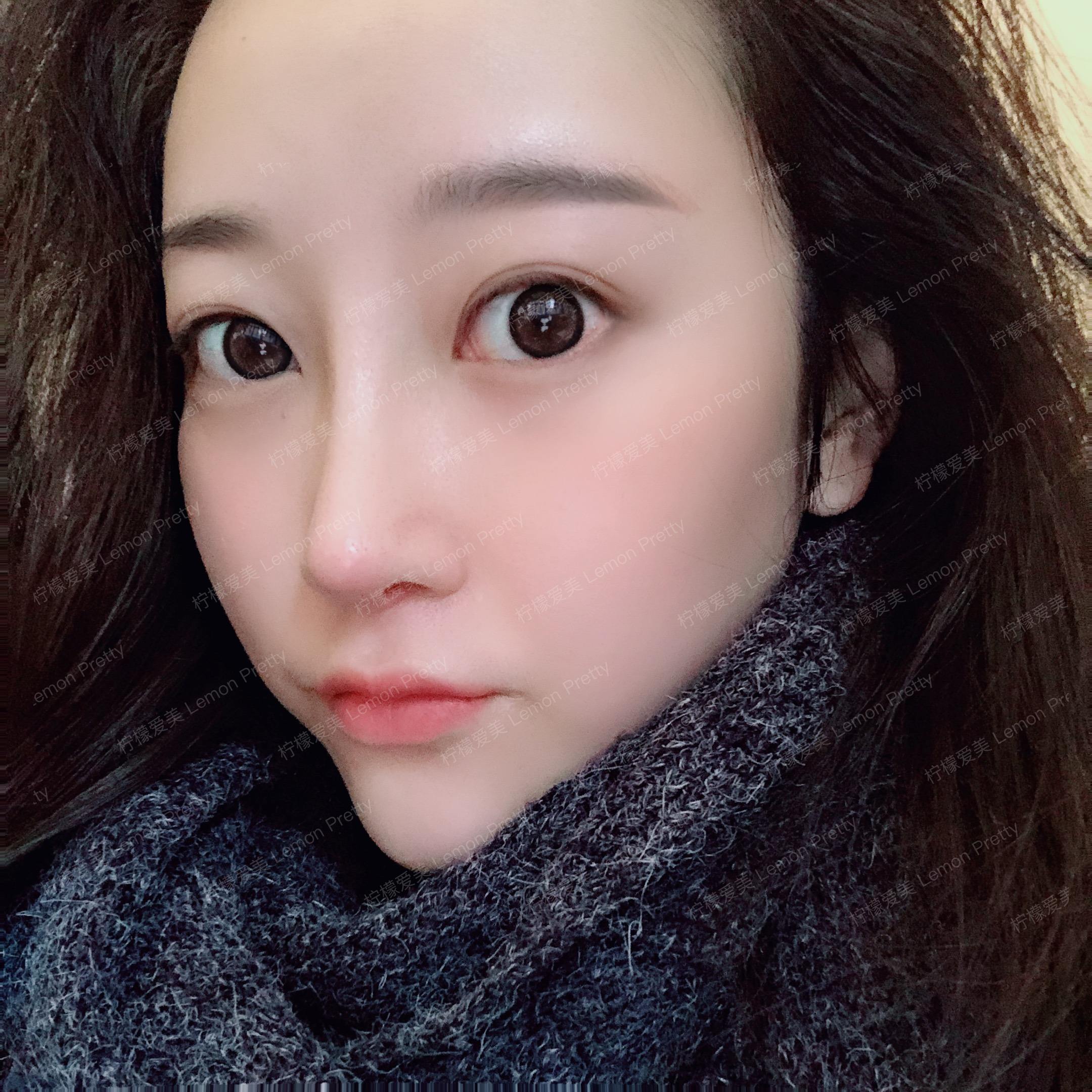 隆鼻有年龄限制吗?