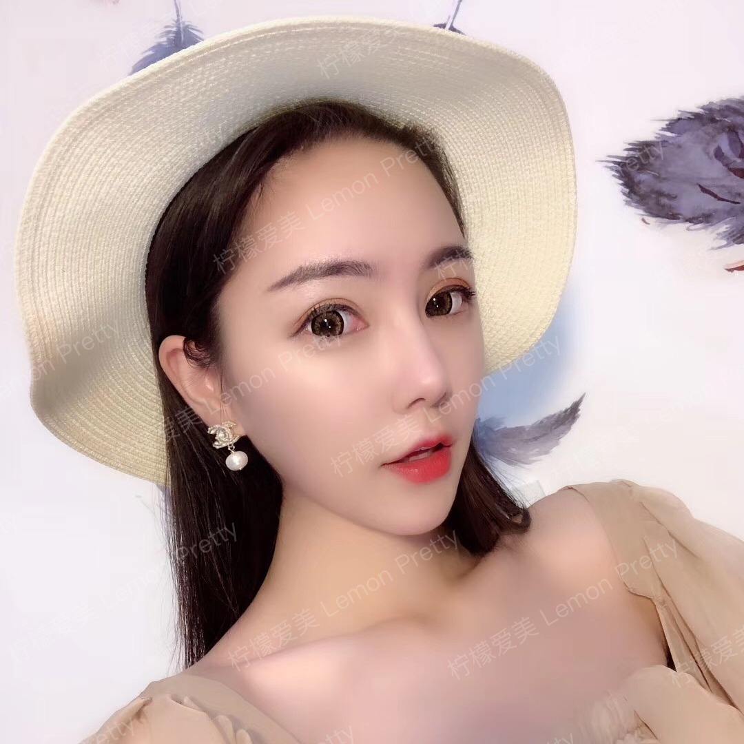 假体隆鼻效果好吗?