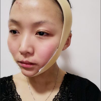 变美日记_真实体验经历_柠檬爱美_咬肌切除