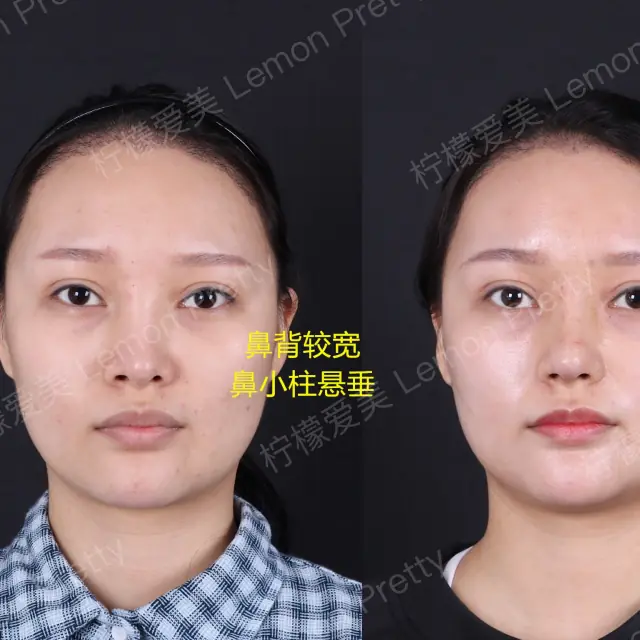 多次鼻整形失败案例分享 柠檬爱美 鼻部修复 多次鼻整形失败案例分享 柠檬爱美 鼻部修复