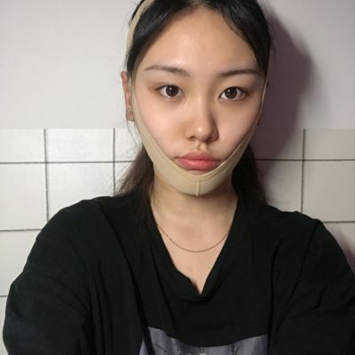 变美日记_真实体验经历_柠檬爱美_咬肌切除