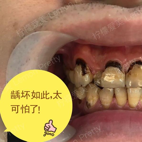 满口烂牙有多恐怖?