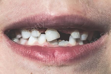 牙齿缺失怎么办?如何选择适合自己的牙齿修复方法?_柠檬爱美_种植牙