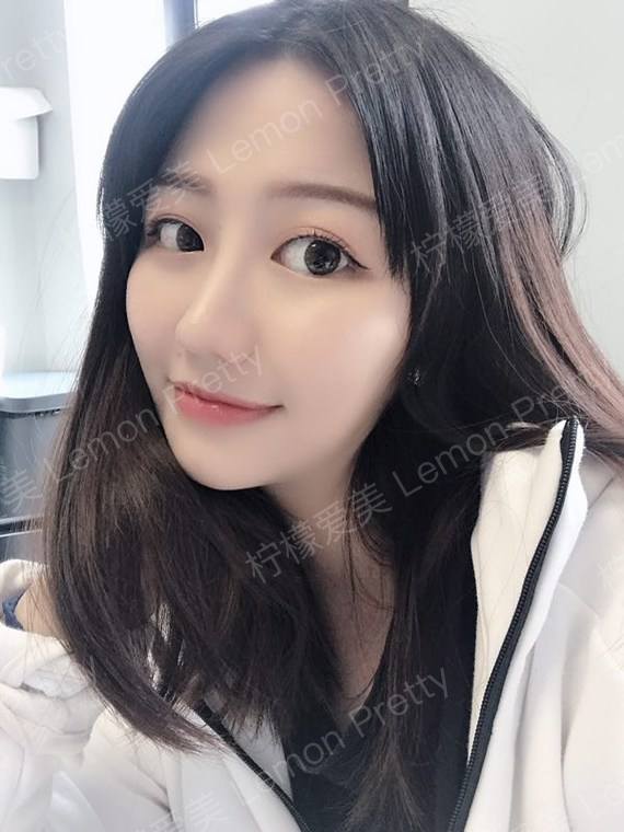 自体肋软骨隆鼻,三个月了来看看什么情况吧