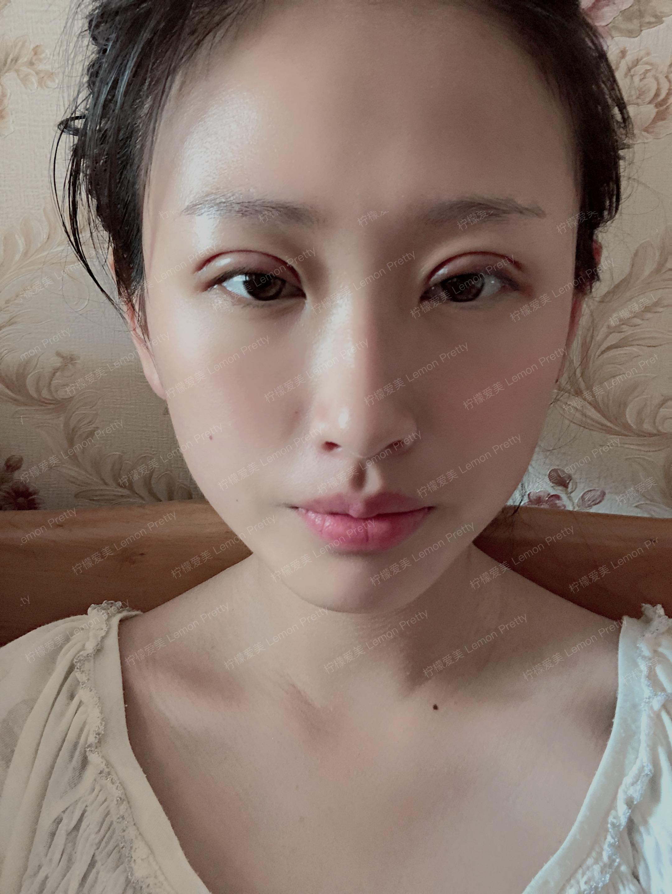 【真人案例】只看术后第1天,我还以为这双眼皮割坏了