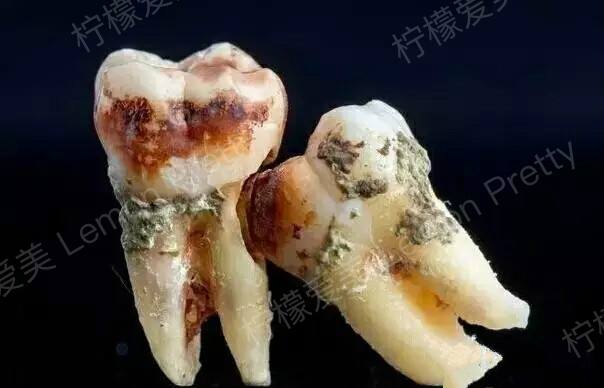 什么是智齿?对人体有什么危害?智齿是否都要拔除?