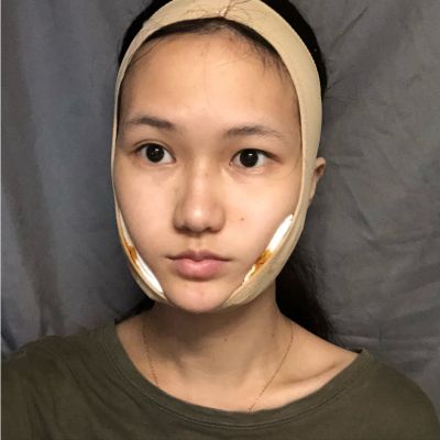 变美日记_真实体验经历_柠檬爱美_咬肌切除
