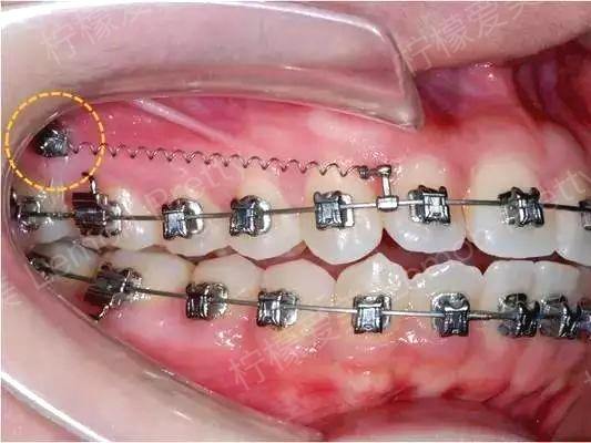 柠檬爱美_陶瓷自锁托槽,金属托槽矫正,隐形托槽矫正