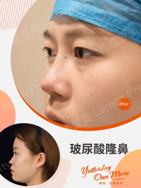 【变美小课堂】玻尿酸又能保湿又能垫鼻子?