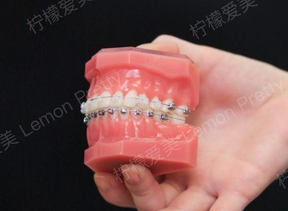 矫正牙齿,金属和陶瓷牙套哪个好?