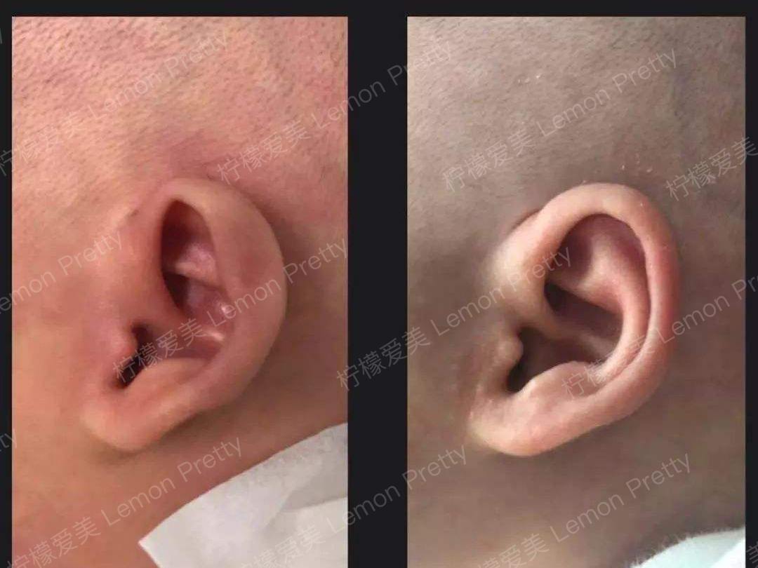 招风耳又称扁平耳或煽风耳,由于对耳轮发育不全或缺如,耳甲软骨谷度