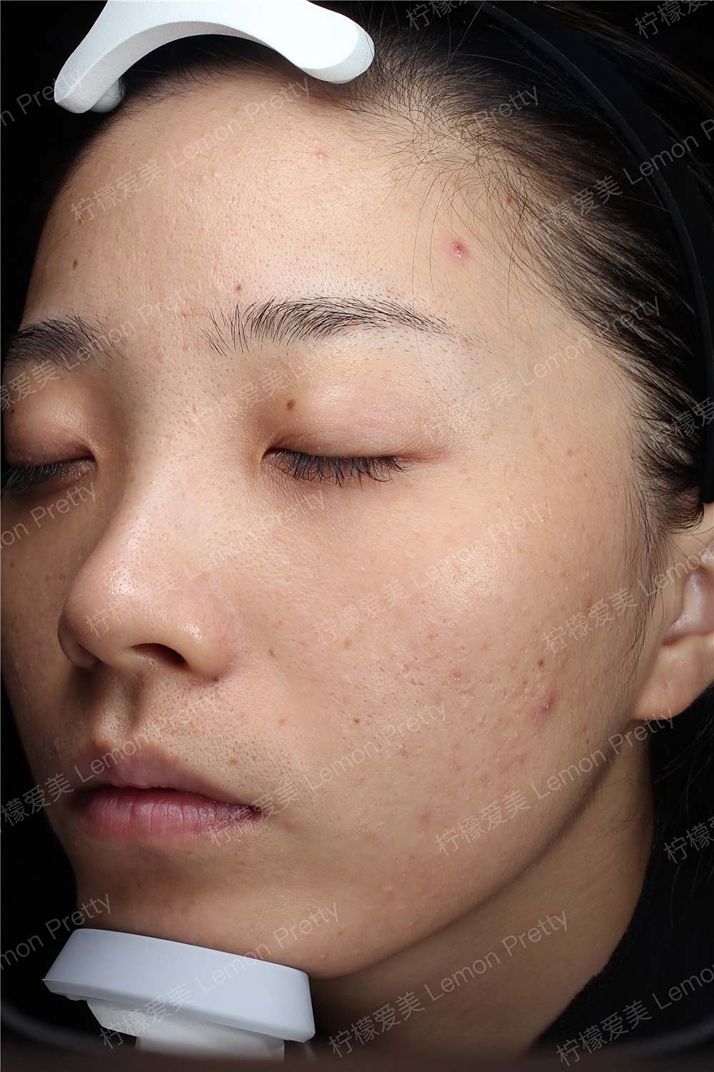 果酸换肤_柠檬爱美_果酸焕肤