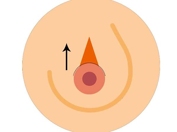 哪有做乳头乳晕整形的呢?做完会留疤吗?