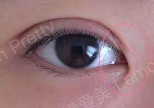 眼角内眦皮赘肉