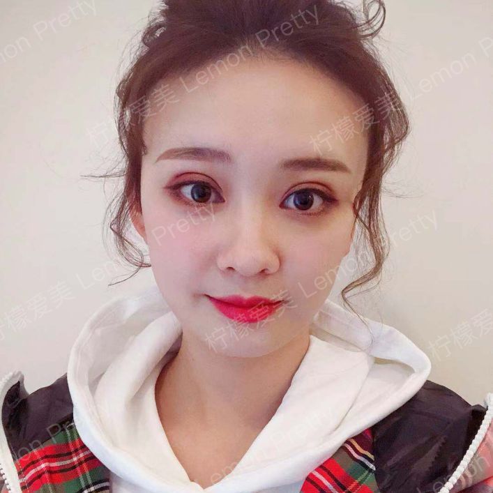 割完双眼皮刀口处鼓包怎么处理?