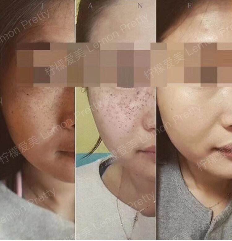 激光祛斑后不能吃的有哪些有什么作用呢?