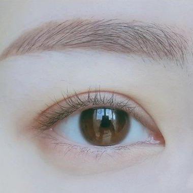 做双眼皮的第四天,想问一下是没有消肿还是割坏了?