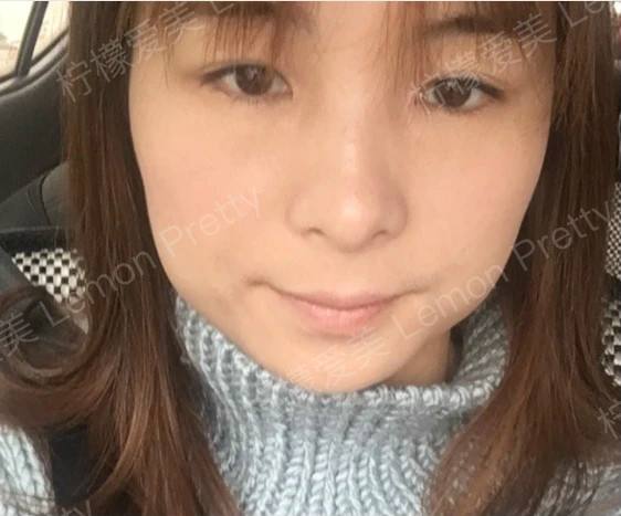 为什么你打完瘦脸针后脸很僵硬?