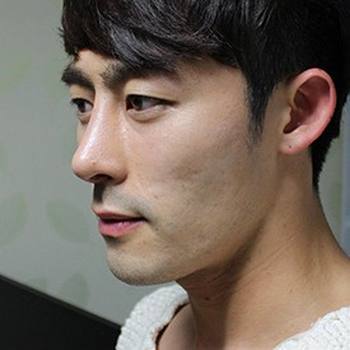 鹰钩鼻的形成原因及矫正方法